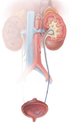 location of the stent in the bladder and kidney