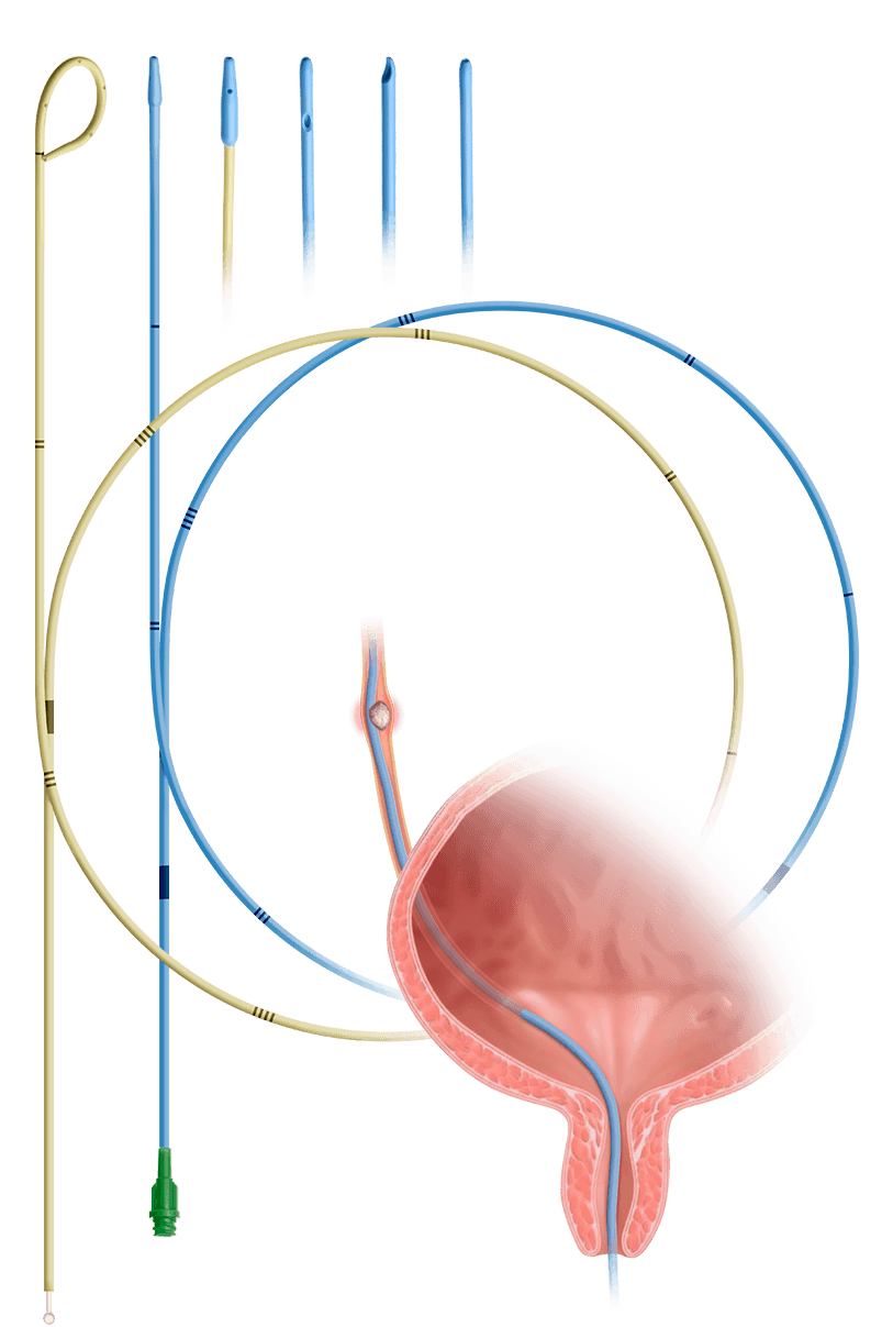 Ureteral catheters